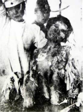 原爆の熱線を浴び、皮膚が溶け落ちた女性